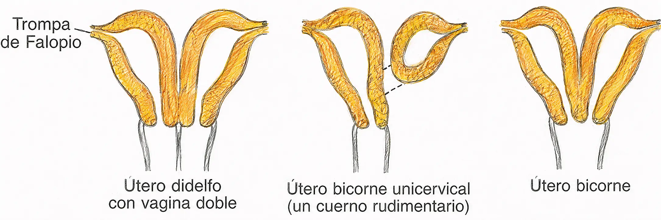 Ilustración comparativa de anomalías müllerianas con útero didelfo, útero bicorne unicervical con cuerno rudimentario y útero bicorne.