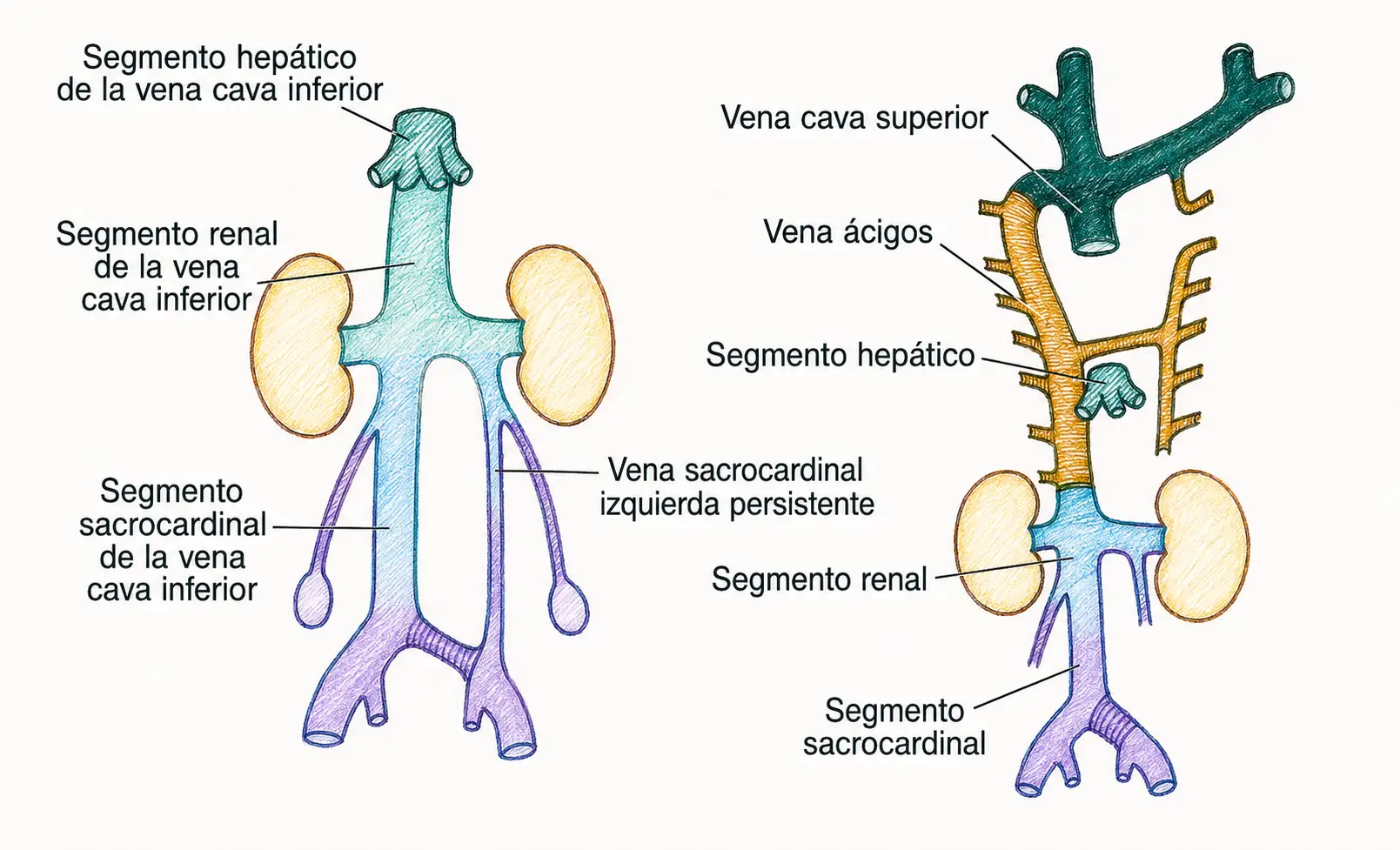 Ilustración embriológica del sistema venoso cardinal y sus derivados adultos, incluyendo vena cava superior, ácigos, hemiácigos, vena renal y segmentos de la vena cava inferior.
