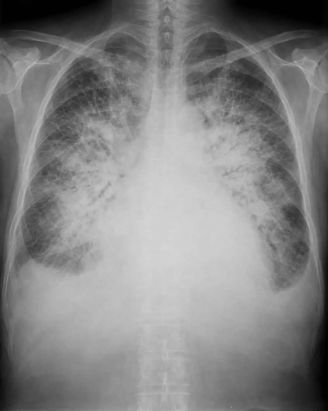 Radiografía de tórax con cardiomegalia, opacidades alveolares perihiliares bilaterales en alas de mariposa y derrames pleurales, compatible con edema agudo de pulmón cardiogénico