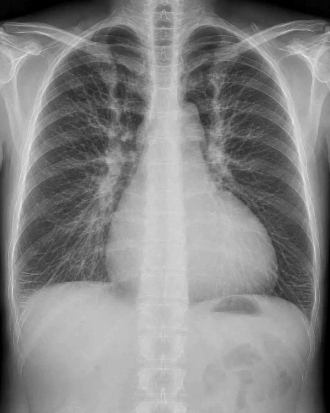Radiografía de tórax con cardiomegalia, redistribución vascular hacia los lóbulos superiores, edema intersticial bilateral y pequeño derrame pleural derecho, compatible con insuficiencia ventricular izquierda